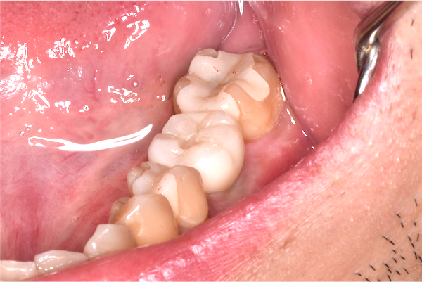 【症例】外部吸収された大臼歯に対する「抜歯即時インプラント」
