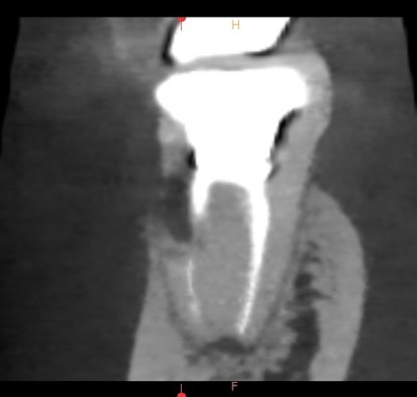 渋谷マロン歯科Tokyo｜【症例】外部吸収された大臼歯に対する「抜歯即時インプラント」｜レントゲン画像
