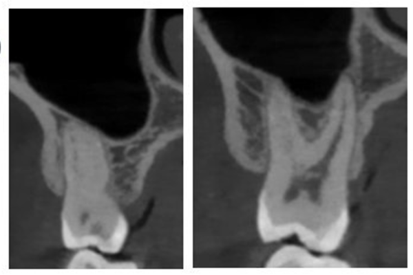 専門治療連携レポート画像3｜【症例】深い虫歯（大きい虫歯）に対する神経を残した治療｜渋谷の歯医者｜渋谷マロン歯科Tokyo