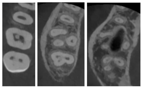 専門治療連携レポート画像4｜【症例】深い虫歯（大きい虫歯）に対する神経を残した治療｜渋谷の歯医者｜渋谷マロン歯科Tokyo
