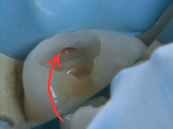 実際の虫歯の入り口｜【症例】深い虫歯（大きい虫歯）に対する神経を残した治療｜渋谷の歯医者｜渋谷マロン歯科Tokyo