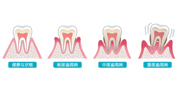 歯周病の進行度のイメージ画像｜【歯周病で歯がグラグラ】抜歯せずに治療できる可能性は？ | 渋谷の歯医者「渋谷マロン歯科Tokyo」