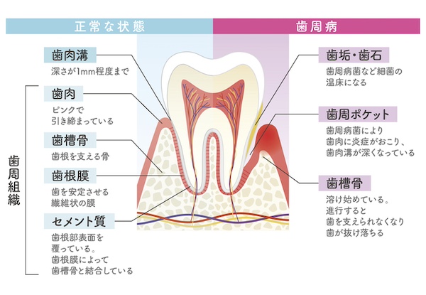 歯周病の進行度のイメージ画像｜【歯周病で歯がグラグラ】抜歯せずに治療できる可能性は？ | 渋谷の歯医者「渋谷マロン歯科Tokyo」