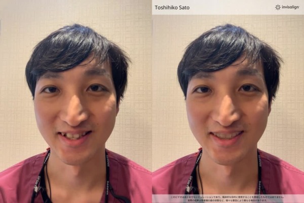 口腔内スキャンの動画before after｜渋谷の歯医者「渋谷マロン歯科Tokyo」