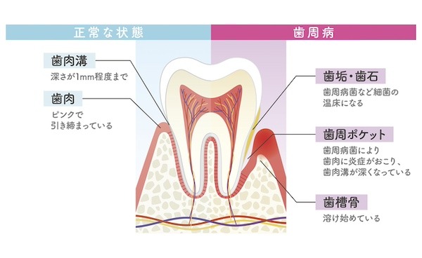 正常な状態と歯周病の状態｜歯茎が下がってきたと感じたら｜考えられる7つ原因と治療法｜渋谷の歯医者「渋谷マロン歯科Tokyo 」