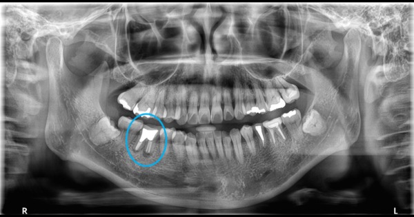 【症例】右下６臼歯部抜歯即時インプラント埋入