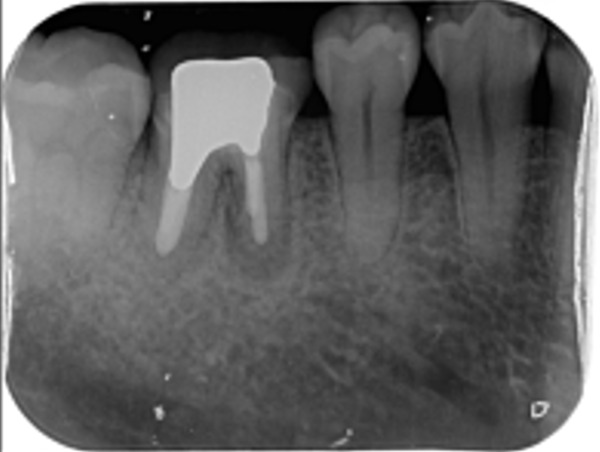 治療前のレントゲン写真｜【症例】右下６臼歯部抜歯即時インプラント埋入｜渋谷の歯医者｜渋谷マロン歯科Tokyo