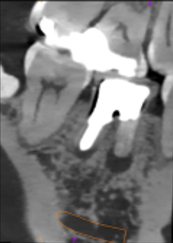 【症例】右下６臼歯部抜歯即時インプラント埋入｜渋谷の歯医者｜渋谷マロン歯科Tokyo