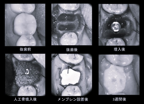 抜歯即時インプラント治療の流れ｜【症例】右下６臼歯部抜歯即時インプラント埋入｜渋谷の歯医者｜渋谷マロン歯科Tokyo
