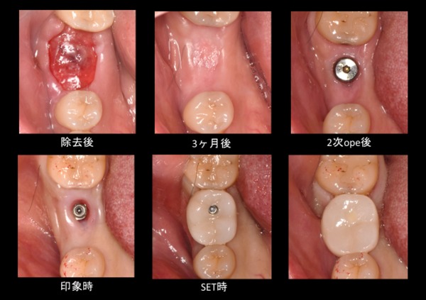 抜歯即時インプラント治療の流れ｜【症例】右下６臼歯部抜歯即時インプラント埋入｜渋谷の歯医者｜渋谷マロン歯科Tokyo