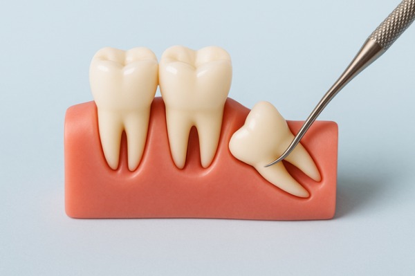 親知らずが斜めに生えている模型|親知らずの痛みがひどいときの対処法と受診の目安|渋谷の歯医者なら渋谷マロン歯科Tokyo