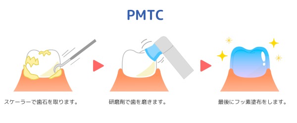 PMTC｜歯石を放置する5つのリスクと自分で除去しようとする危険性｜渋谷の歯医者なら渋谷マロン歯科Tokyo