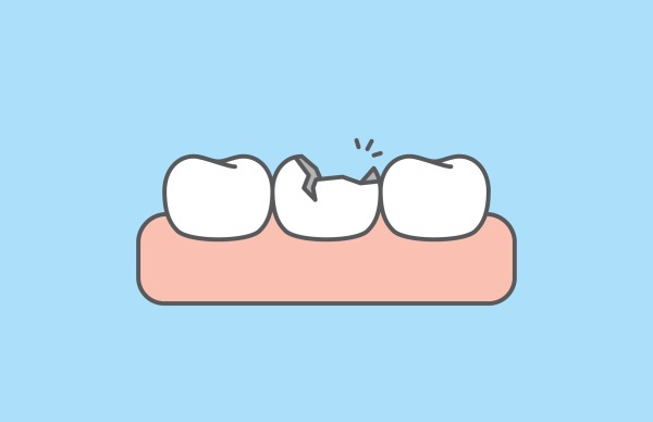 歯が折れた画像｜歯をぶつけた・折れたときの正しい応急処置と歯科での治療法｜渋谷の歯医者なら渋谷マロン歯科Tokyo