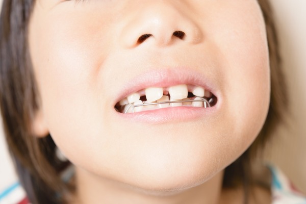 小児矯正の器具を付けている子ども｜小児矯正は何歳から始める？ベストなタイミングと費用の目安｜渋谷の歯医者なら渋谷マロン歯科Tokyo