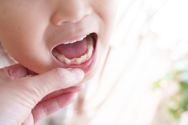 小児矯正は何歳から始める?ベストなタイミングと費用の目安