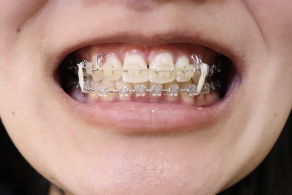 ワイヤー矯正治療｜矯正中に虫歯になったらどうする？治療とセルフケアの具体的な方法｜渋谷の歯医者なら渋谷マロン歯科Tokyo